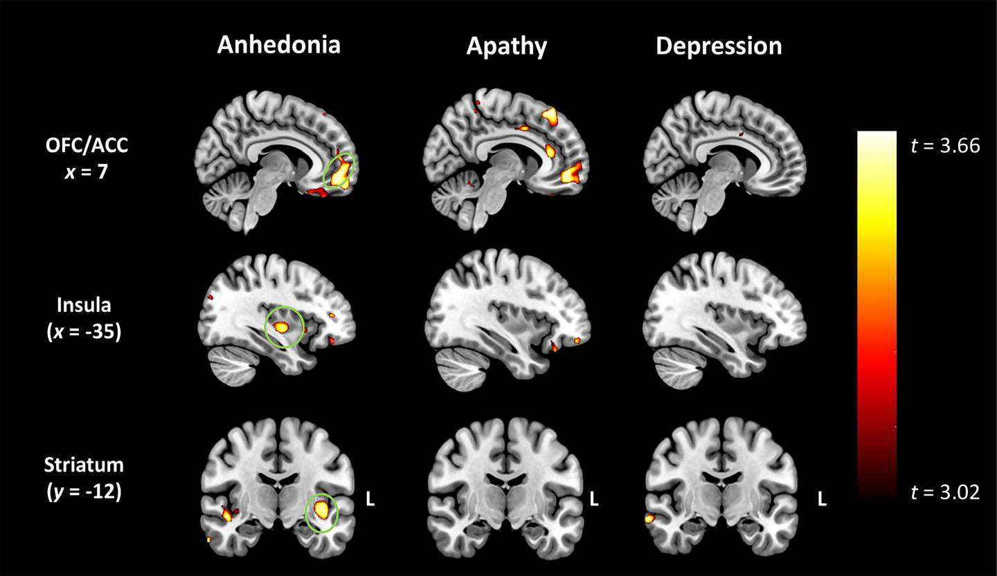 image for Profound loss of pleasure related to early-onset dementia
