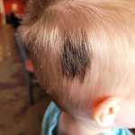 image for My son was born with a black spot of hair in his blonde hair. It grows in black, and there is no birth mark or discoloration under it.