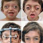 image for This is how the cosmetic correction of a child with Crouzon syndrome was done. He even showed a significant improvement in vision and breathing
