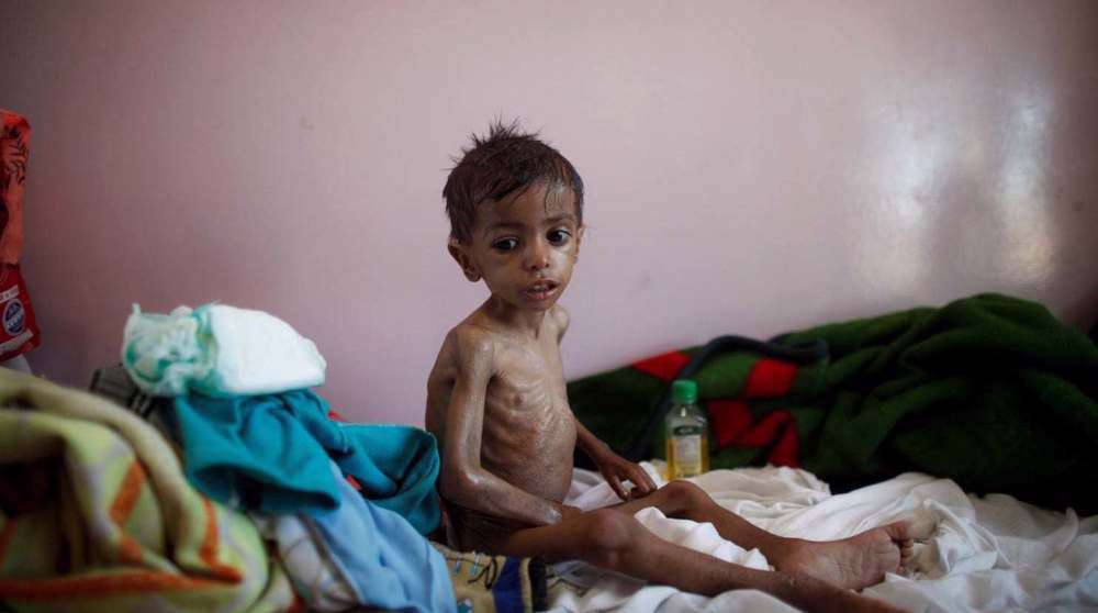 image for One child in Yemen dies every five minutes as half of medical facilities are out of service: Health Ministry