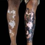 image for Turning vitiligo disease to an art