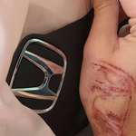 image for Honda logo burned into my hand from steering wheel airbag deployment