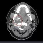 image for The aneurysm in my head. I have risky surgery tomorrow. Positive thoughts everyone.