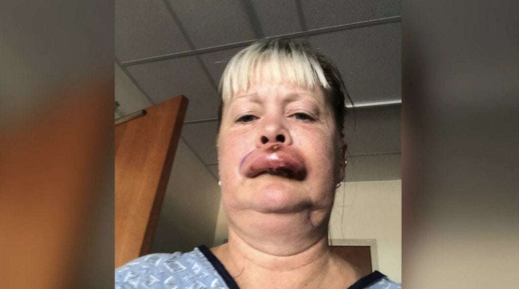 image for Virginia woman left hospitalised and hallucinating after venomous spider bites her lip
