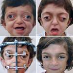 image for A boy with Crouzon Syndrome gets a new life.