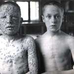 image for Both these kids had active smallpox. Guess which one was vaccinated