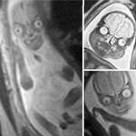 image for MRI scan of baby during pregnancy