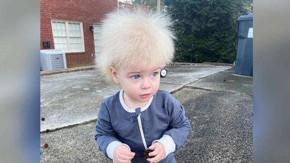 image for Mom raises awareness after son is diagnosed with uncombable hair syndrome