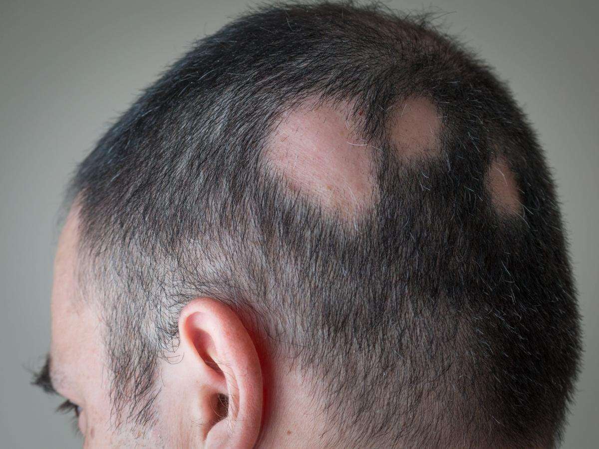 image for A first-of-its-kind alopecia treatment that triggers hair growth was just approved by the FDA