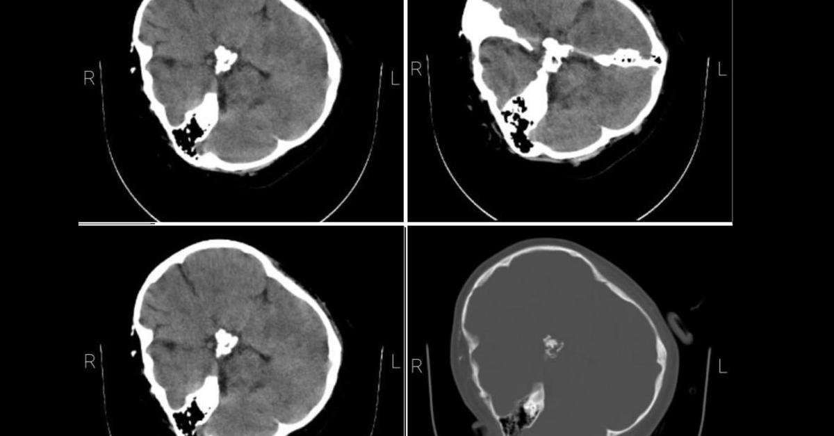 image for Mahsa Amini’s CT Scan Shows Skull Fractures Caused By Severe Blows