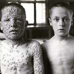 image for One boy was vaccinated for smallpox, and the other was not.