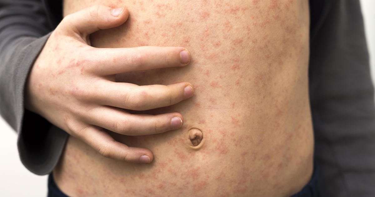 image for At least 82 children in Ohio infected with measles, more than half of whom are unvaccinated babies and toddlers