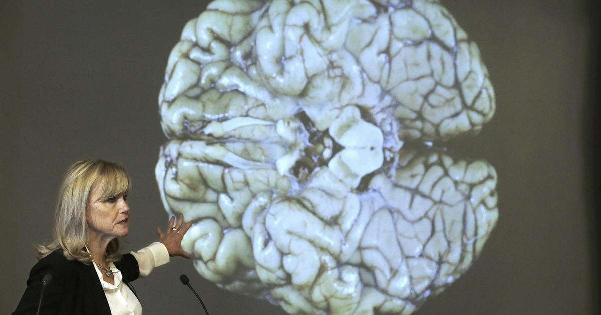 image for CTE found in nearly 92% of former NFL players studied by Boston University