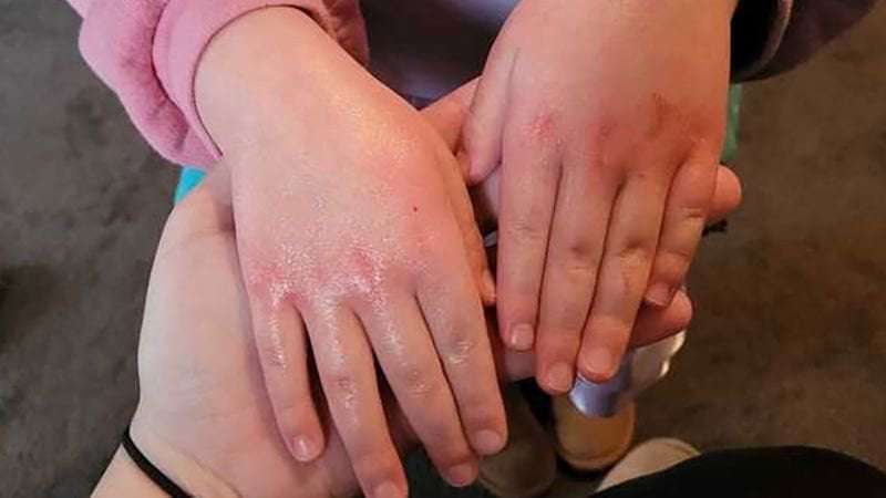 image for East Palestine residents worry rashes, headaches and other symptoms may be tied to chemicals from train crash