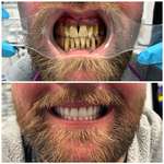 image for (Oc) 6 hours worth of work and brand new fixed teeth.(I’m the dental technician that made the teeth)