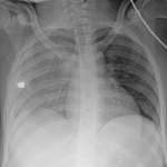 image for Chest x-ray of young girl suffering from #1 cause of death in children / adolescents in the U.S.