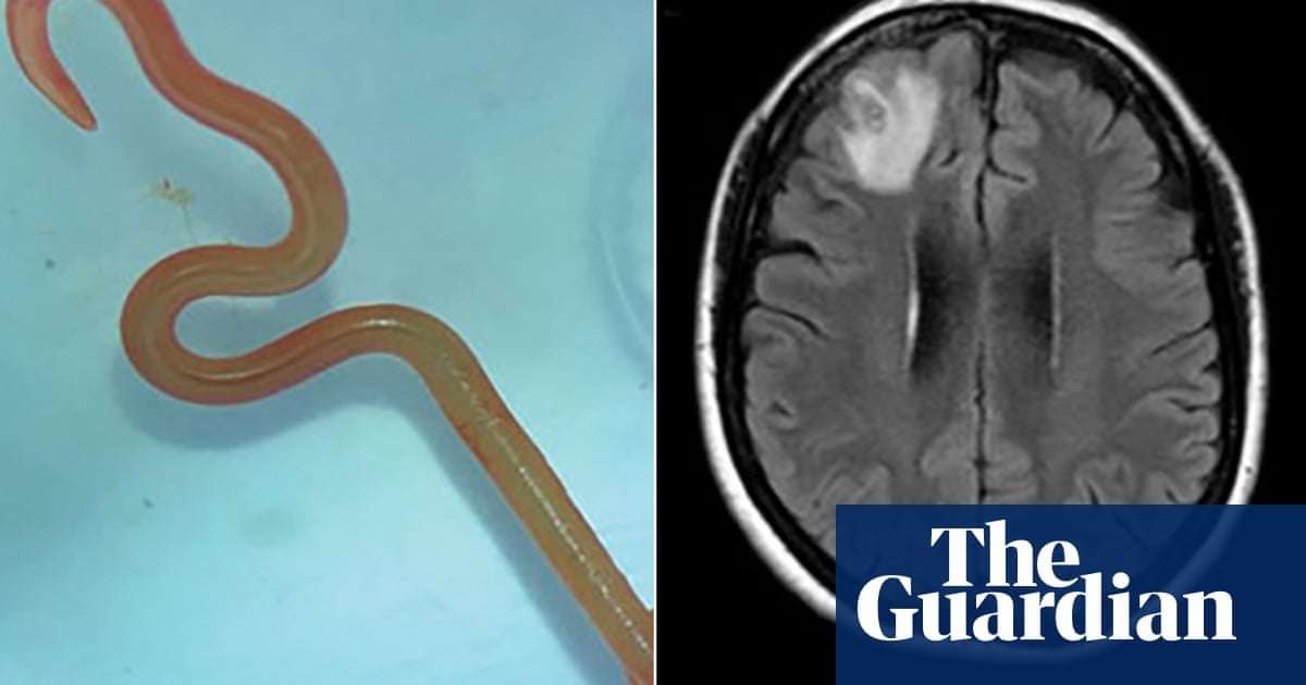 image for ‘Oh my god’: live worm found in Australian woman’s brain in world-first discovery