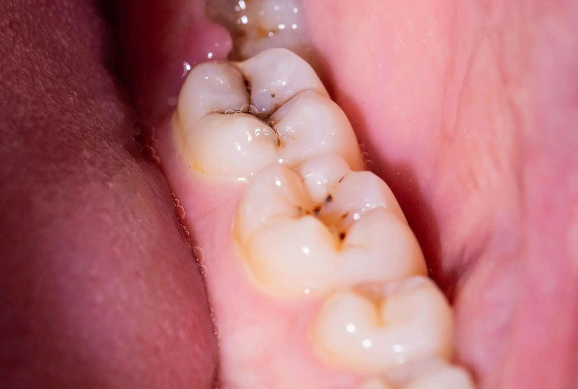 image for 90% Reduction: Scientists Discover Natural Molecule That Eradicates Plaques and Cavities
