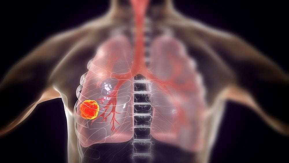 image for Trials show new cancer vaccine could improve patient survival for some lung cancers by nearly half