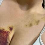 image for This gnarly bruise from a seatbelt (one week after an accident)