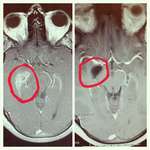 image for My brain before and after brain surgery to remove a tumor.