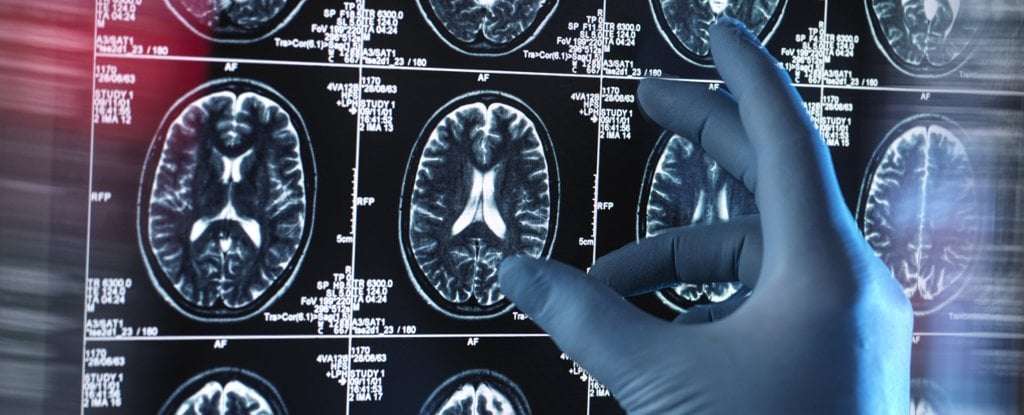 image for Long COVID Seems to Be a Brain Injury, Scientists Discover