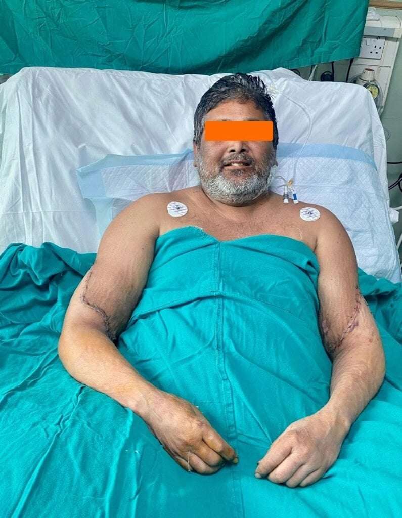 image for A Painter, Who Lost Both Hands in a 2020 Train Accident, Has Successfully Regained His Hands Through Delhi’s Inaugural Bilateral Hand Transplant Procedure at Ganga Ram Hospital