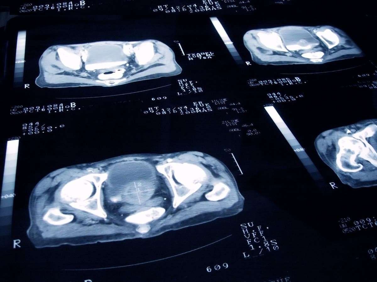 image for AI makes breakthrough discovery in battle to cure prostate cancer