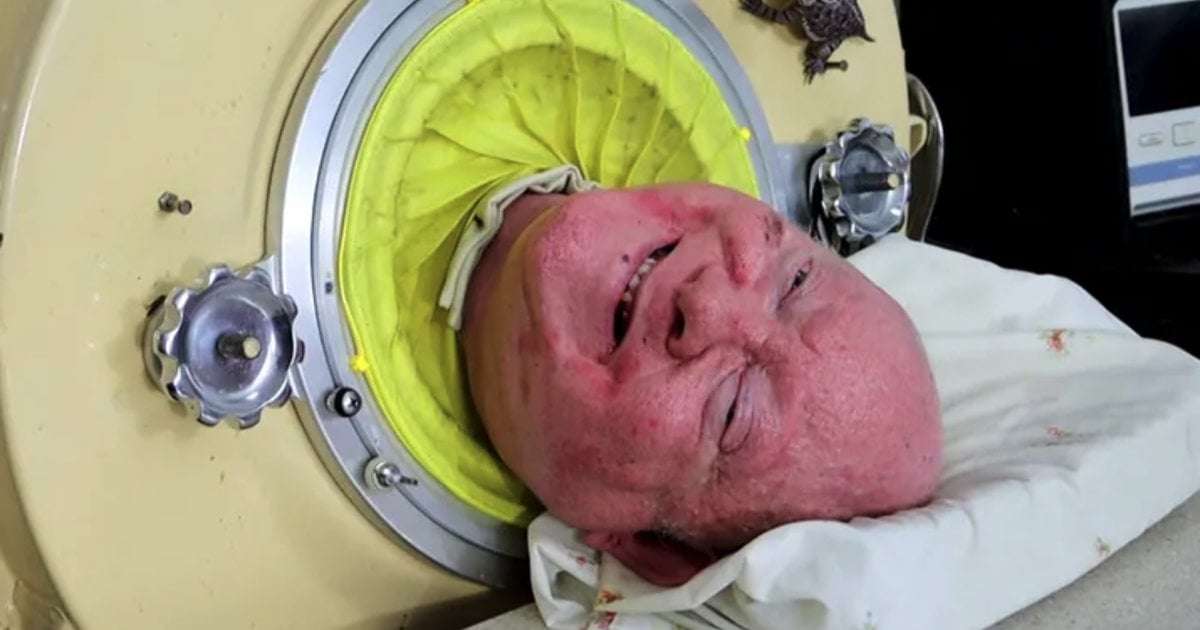 image for Paul Alexander, 78-year-old Dallas man who lived in an iron lung for most of his life, dies
