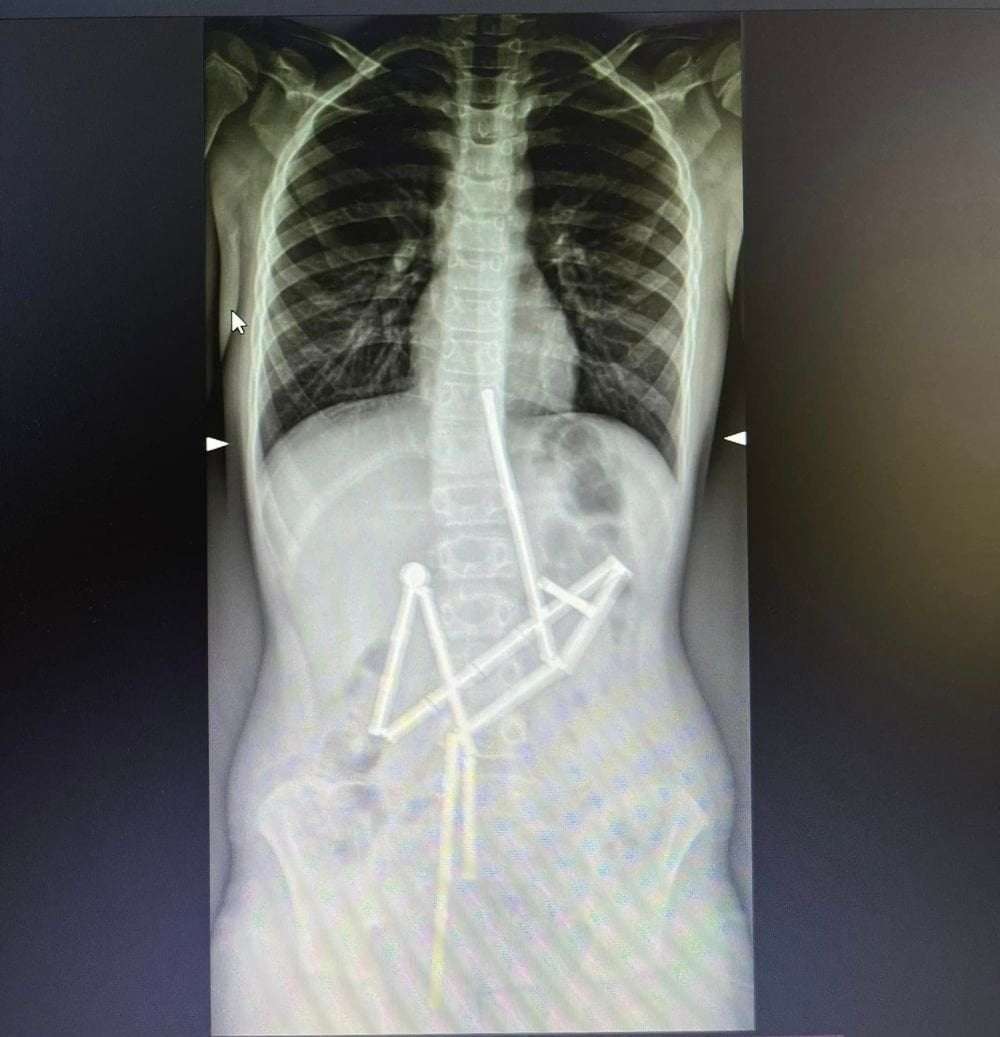 image for Ukrainian doctors save child who swallowed 20 magnets