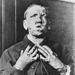 image for A man suffering from leprosy, taken around the turn of the 20th century.