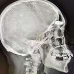 image for Xray reveals cause of long term headaches…
