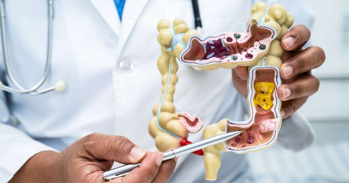 image for A new type of bacteria was found in 50% of colon cancers. Many were aggressive cases.