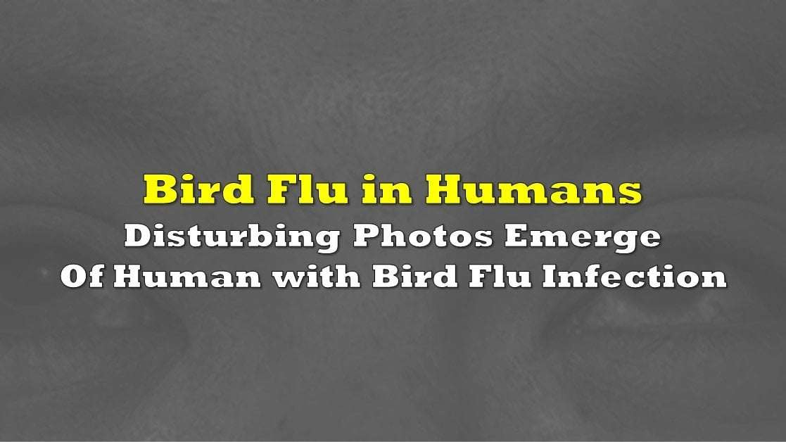 image for Disturbing Photos Emerge of Texas Dairy Worker’s Rare Bird Flu Infection from Cow