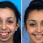 image for Jaw surgery dramatically changes girl's appearance