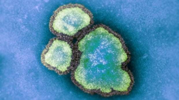 image for Hamilton child under 5 dies of measles: public health agency
