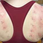 image for I got an allergy test done today.