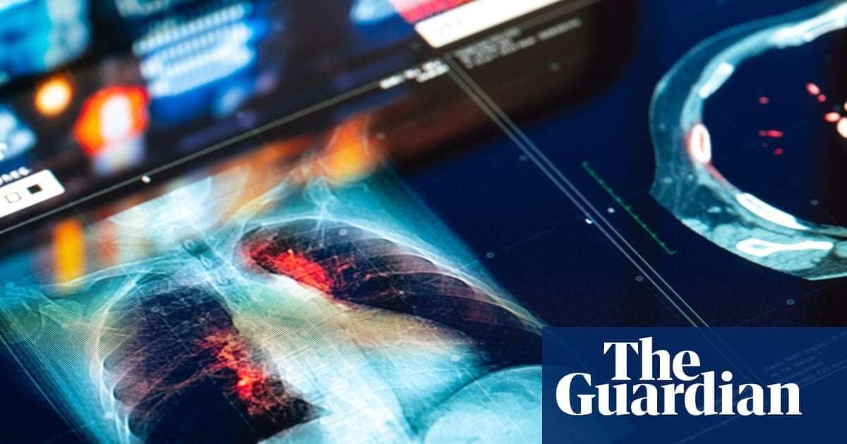 image for Trial results for new lung cancer drug are ‘off the charts’, say doctors
