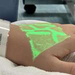 image for There's a device called a Vein Viewer that shows doctors and nurses where your veins are located