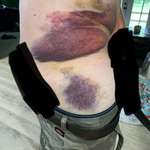 image for The bruise I received after getting thrown from a horse.