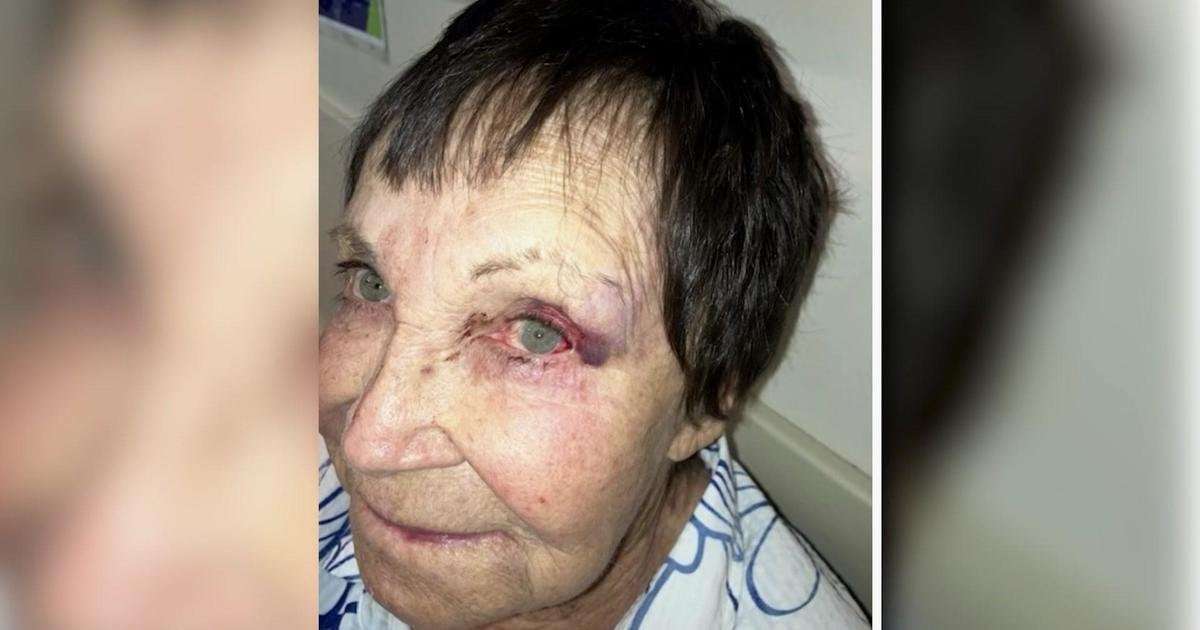 image for 89-year-old stand-up comedian sucker-punched in West Village: "I thought I'd lost my eye"