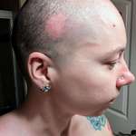 image for Cicatricial Alopecia is so painful. Unfortunately this is lifelong. I just want to spread awareness.