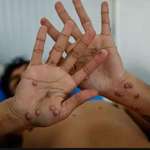 image for Sweden has confirmed the first case of the new variant of monkeypox outside Africa.