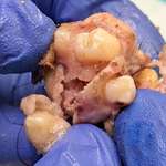image for My friend's tumor in her ovary had teeth