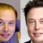 image for Elon's hairline before and after