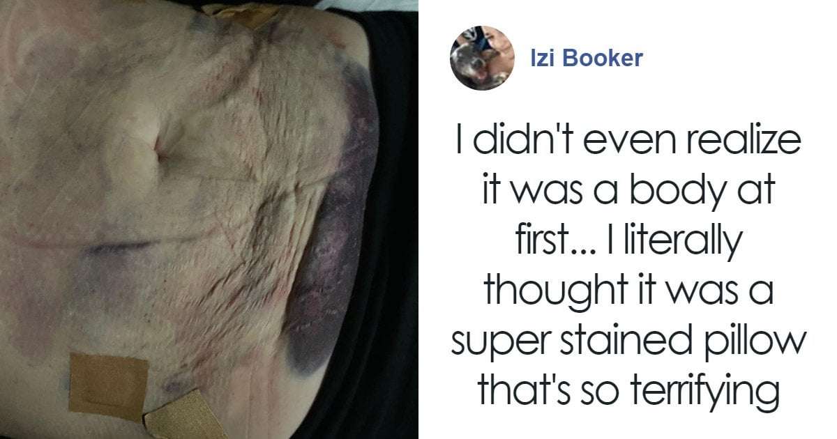 image for Woman Hospitalized After Liposuction Procedure Using AliExpress Dental Phlegm Suction Machine