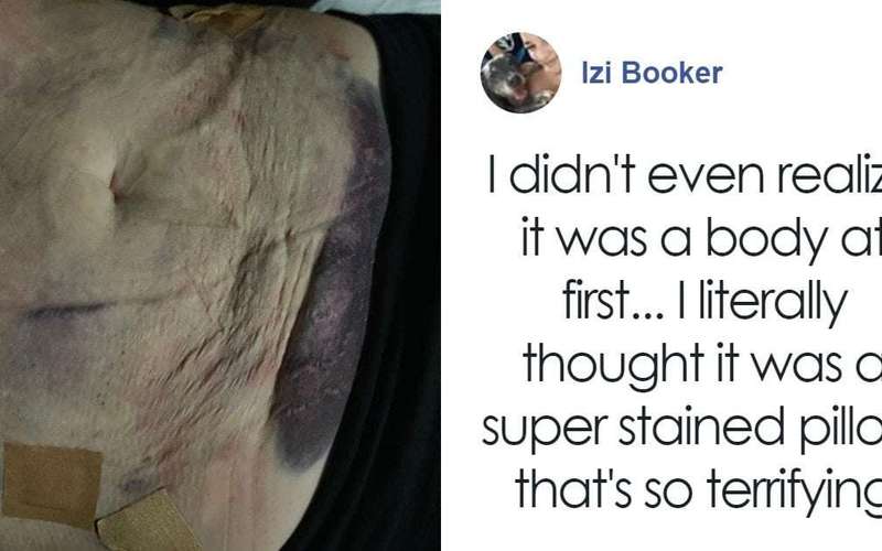 image for Woman Hospitalized After Liposuction Procedure Using AliExpress Dental Phlegm Suction Machine