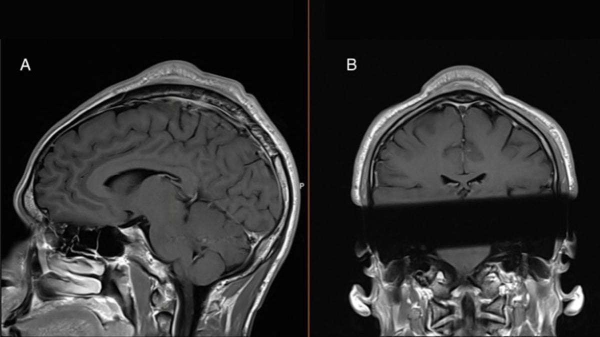 image for Man developed a 'headspin hole' after years of breakdancing, case report says