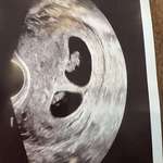 image for After two if miscarriages my beautiful girlfriend is pregnant with twins