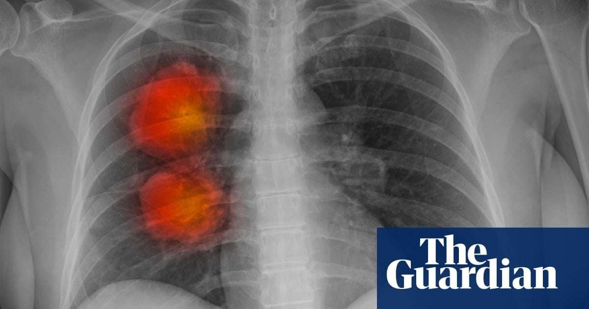 image for Study raises hopes of treating aggressive cancers by zapping rogue DNA